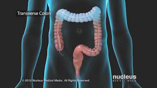 Colon Problems Diverticular Disease [upl. by Beker]