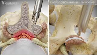 Endoscopic Lumbar Laminotomy  Spine Institute of North America [upl. by Boarer]