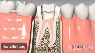 Wie läuft eine Wurzelkanalbehandlung ab  Wurzelbehandlung beim Zahnarzt [upl. by Suanne945]