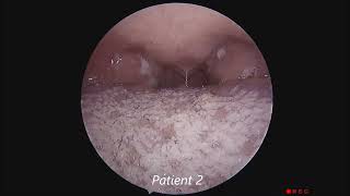 Acute Membranous Tonsillitis [upl. by Phineas]