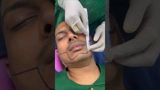 Beard Transplantation  Before After Beard Transplant Bangladesh beardtransplant beard duetviral [upl. by Notsek]