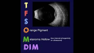 TFSOM DIM Risk Factors for Choroidal Nevus Growth to Melanoma [upl. by Artenek189]