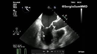 MITRAL REGURGITATION TRANSESOPHAGEAL ECHOCARDIOGRAPHY TEE  CASE 4 [upl. by Ardnola]