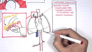 Lung Carcinoma Lung cancer [upl. by Eirellam]