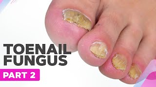 How to Deal with Nail Fungus Part 2  Onychomycosis [upl. by Whitebook]