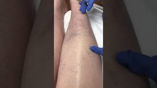 Sclerotherapy leg vein treatment with Asclera [upl. by Nemhauser]