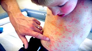 IMPRESSIVE FULL BODY RASH  Live Diagnosis With Dr Paul [upl. by Sawtelle428]