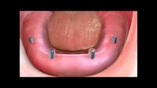 Implant Supported Dentures [upl. by Aicirtan43]