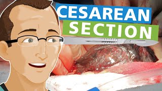 Cesarean Section [upl. by Anitreb]