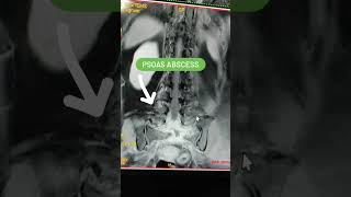 Psoas Abscess Mri Lumbar Spine viral mri shorts [upl. by Yentiw]