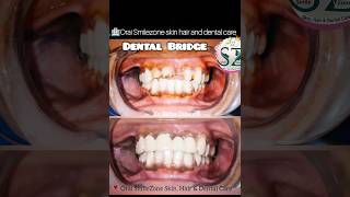 Dental Bridge get back your smile dental crown dentalclinic dentalcrown oraismilezone [upl. by Anirtac477]