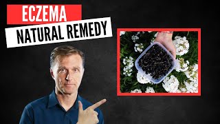 Best Natural Remedy for Eczema [upl. by Datha]