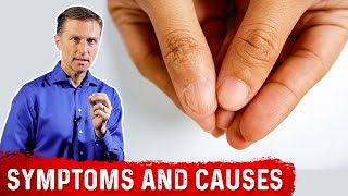 Iron Deficiency Symptoms and Causes of Anemia – DrBerg [upl. by Jamesy78]