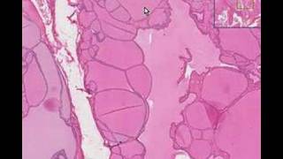 Histopathology ThyroidColloid goiter [upl. by Hploda276]