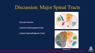 Traumatic Brown Sequard Syndrome A Review of Anatomy and Imaging [upl. by Teresa420]