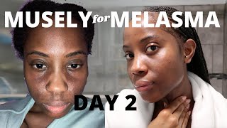 Musely Spot Cream for Melasma Day 2 [upl. by Demetria]