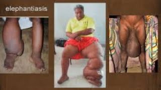 Comment soigner naturellement l’ELEPHANTIASIS [upl. by Valentin839]