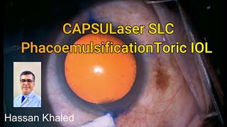 CAPSULaser SLC  PhacoemulsificationToric IOL [upl. by Cayser]