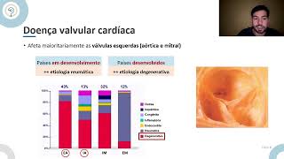 Medicina  Cardiopatia valvular  aórtica e mitral [upl. by Ayaj]