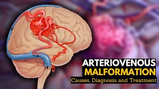 Arteriovenous Malformation Causes Signs and Symptoms Diagnosis and Treatment [upl. by Gensler]