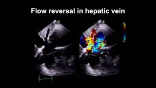 Echocardiography Essentials Spotting tricuspid and pulmonary valve disease [upl. by Dorr]