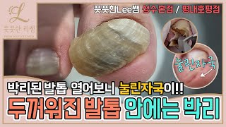 두꺼워진 발톱 안에가 박리되어 있는데 열어보니 눌린자국이 tinea unguium  athletes foot  Fresh Foot 풋풋한리쌤 성수점  평내호평점 [upl. by Eisserc]