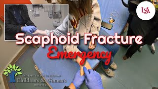 Scaphoid Bone Fracture Emergency [upl. by Ellynad]