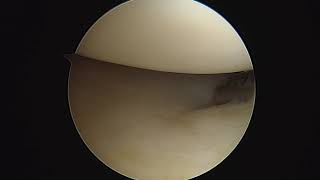 R knee chondroplasty 8 5 21 AM [upl. by Klehm]