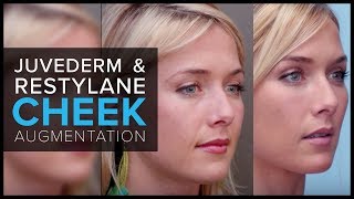 Cheek Augmentation With JUVEDERM® and Restylane® at Mabrie Facial Institute [upl. by Acirt]