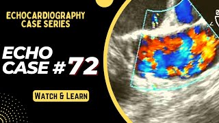 ECHO CASE 72  Echocardiography for Beginners  Echo spot diagnosis Series  Cardiology [upl. by Aihtekal444]