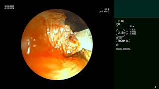 Adenoid cystic carcinoma of Trachea  Silicone Y stent  Complications Bronchoscopic management [upl. by Teillo351]