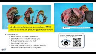 Pancreas Mucinous cystic neoplasm Gross pathology [upl. by Dannel]