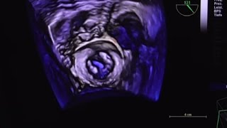 post rheumatic mitral valve stenosis [upl. by Letsirhc777]