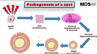 3 Pathogenesis of a cyst [upl. by Plusch831]