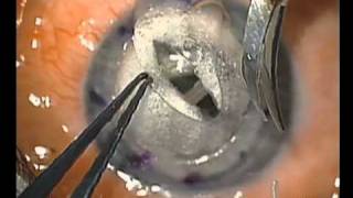 quotDouble Bubblequot Deep Anterior Lamellar Keratoplasty [upl. by Nosnorb]