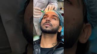 Nose Par Bhi Injection 🤣 Micky Makeover [upl. by Sunev]