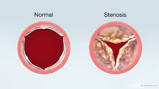 Transcatheter Aortic Valve Replacement TAVR Treatment for Aortic Stenosis [upl. by Costin551]