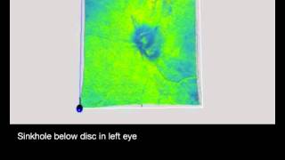 Myopic Peripapillary Sinkhole [upl. by Agnese]