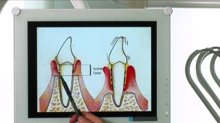 Diagnosi e cura per la piorrea o malattia parodontale [upl. by Ginelle]