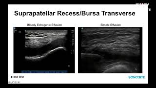 Webinar Ultrasound Evaluation of the Anterior Knee [upl. by Chin]