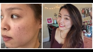 Review Sản Phẩm Trị Thâm Mụn Hiệu Quả  How to Get Rid Of Acne Scars  TrinhPham [upl. by Baylor]