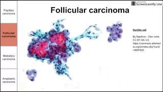 Thyroid Cancers [upl. by Olracnaig]