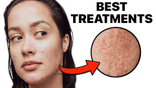 How To Get Rid of Acne Scars [upl. by Chantalle]