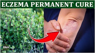 How To Treat Eczema with Oregano Oil  Natural Remedies for Eczema Treatment [upl. by Frasco18]