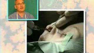 Estetska operacija nosa nose surgery Dr Glusac [upl. by Mckale]