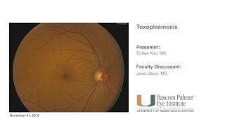 Bascom Palmer Grand Rounds  Toxoplasmosis [upl. by Nancy441]