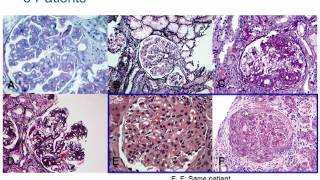 Understanding Membranoproliferative Glomerulonephritis Part 2 Hot Topic [upl. by Hsirahc]