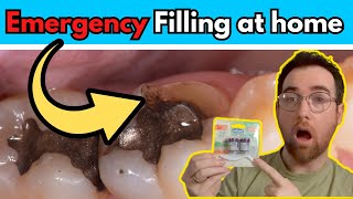 DIY Tooth filling Using Temporary filling material at home [upl. by Atelokin90]