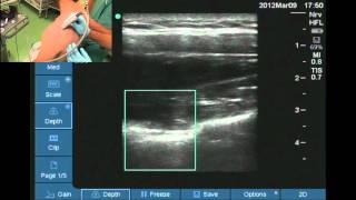 Suprascapular nerve location [upl. by Nesline]