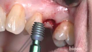 The Bicon SHORT® Implant Surgical Technique [upl. by Aprile337]